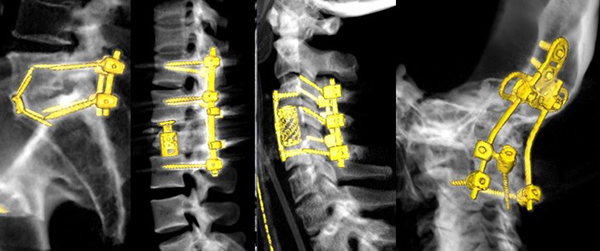 Röntgenbild på en rygg