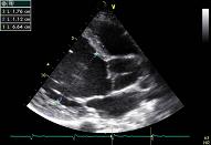 Aortic valve, patient nr 1:2 - Severe aortic insufficiency