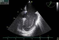 ASD el PFO, VSD, ductus, patient 2:3 - Large ventricular septal defect