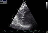 4 Myocardial infarction- complication (an, VSD, MR)\MI-complication, pat nr 4 (VSD)