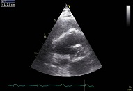 7 Pericardial and pleural effusion/Coagulation outside the right ventricle causing tamponade after heart surgery (patient 2:2, SAX)