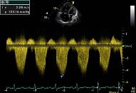 Pulmonary hypertension, patient 3:4 - PHT with large TI